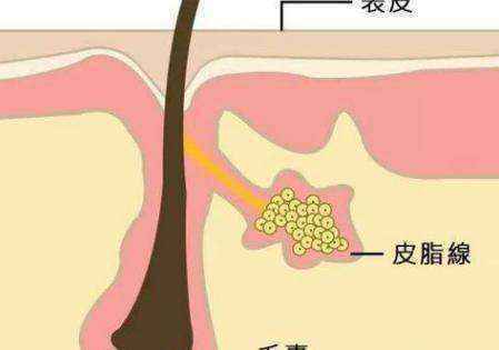 混合性皮肤